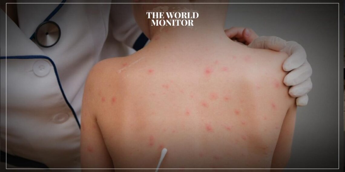 Greece on High Alert Due to Monkeypox