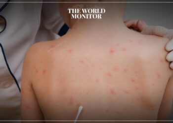 Greece on High Alert Due to Monkeypox