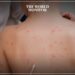 Greece on High Alert Due to Monkeypox