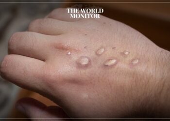 Philippines Reports 1st Mpox Case